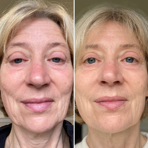 Renueva, Repara y Revitaliza - Máscara LED BeautySkin™