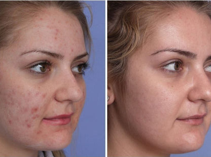 Renueva, Repara y Revitaliza - Máscara LED BeautySkin™